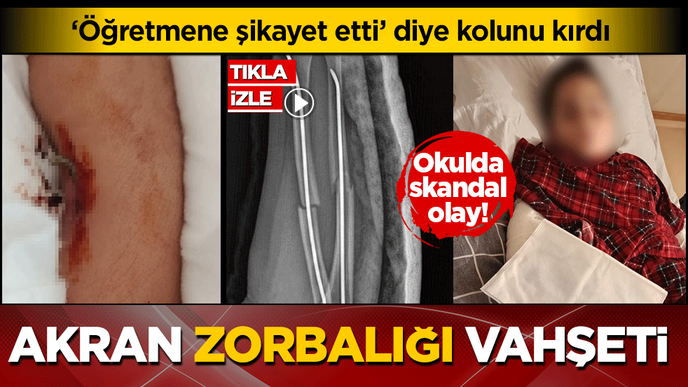 Okulda akran zorbalığı vahşeti: ‘Öğretmene şikayet etti’ diye arkadaşının kolunu kırdı