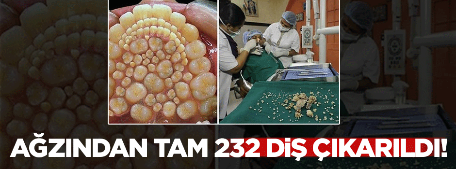 Öyle tuhaf hastalıkları var ki: Ağzından tam 232 diş çıkarıldı!