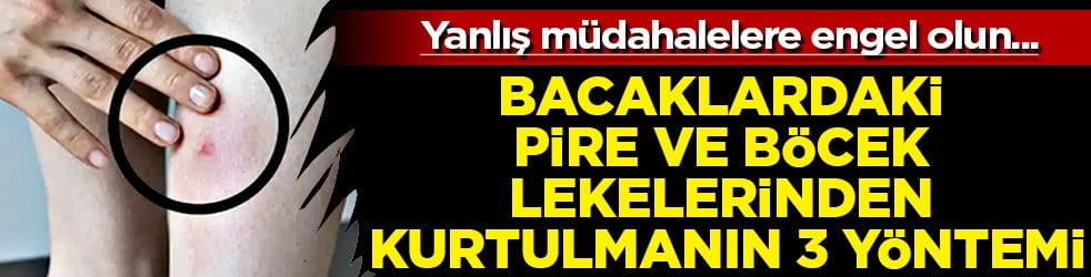 Pire ve böcek lekelerinden bir an önce kurtul: Vücudun her tarafı kabartı, soyulma var diyenler! Bunu yapın olacak
