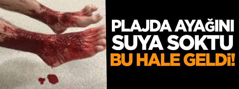 Plajda ayaklarını suya soktu, bu hale geldi