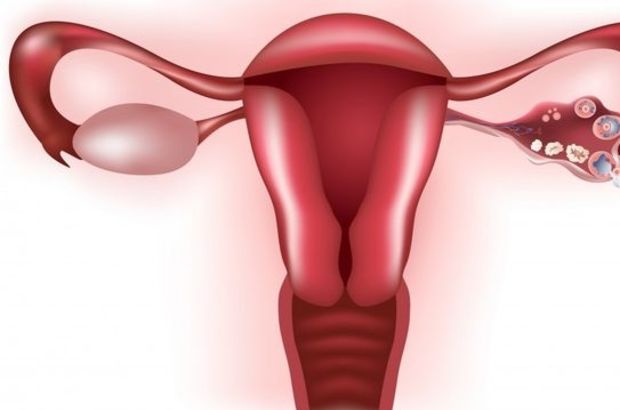 Polikistik over kısır yapar mı?