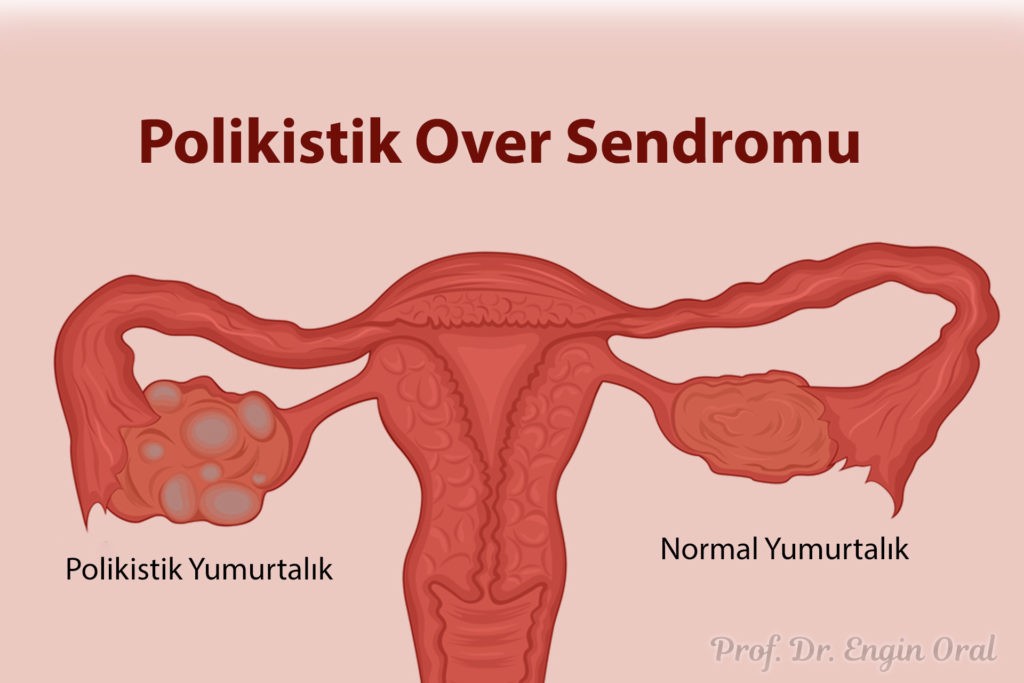 Polikistik over kisti nedir?