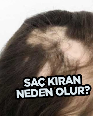 Saç kıran neden olur? Çoğu kişinin yaşadığı hastalığa karşı çözüm