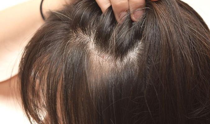 Saçkıran nedir? Tüy köklerinin geri gelmesi mümkün mü?