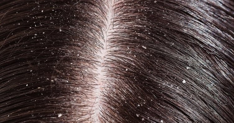Saçta kepek ve kabuklanma neden olur?