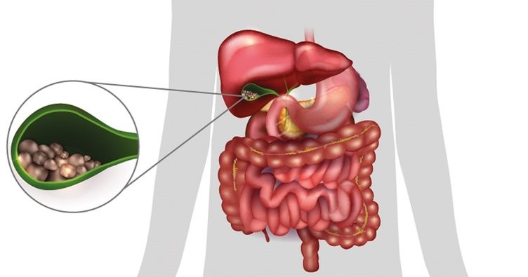 Safra kesesi hastalığı belirtileri nelerdir?