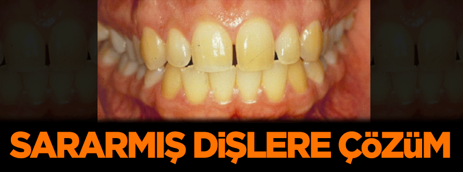 Sararmış dişlere çözüm