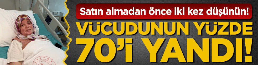 Satın almadan önce iki kez düşünün: Vücudunun yüzde 70'i yandı!