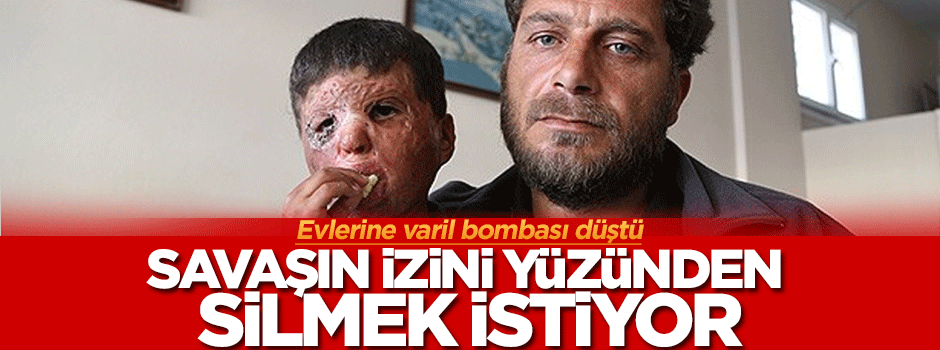 Savaşın izini yüzünden silmek istiyor