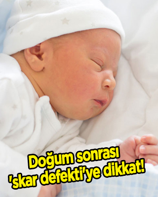 Sezaryen skarı nedir, belirtileri? İstmosel nasıl anlaşılır? Sezaryen doğum sonrası 'skar defekti'ye dikkat!