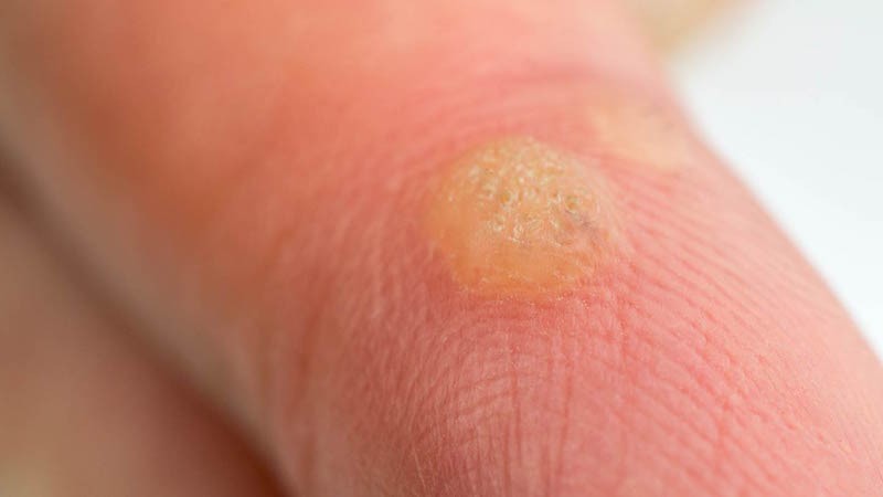 Siğilden kurtulmanın yolları | Siğiller nasıl geçer?