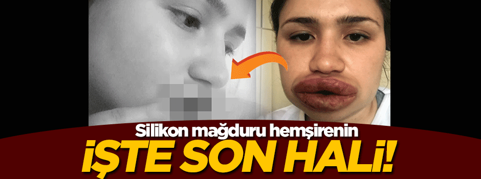 Silikon mağduru hemşire düzeliyor