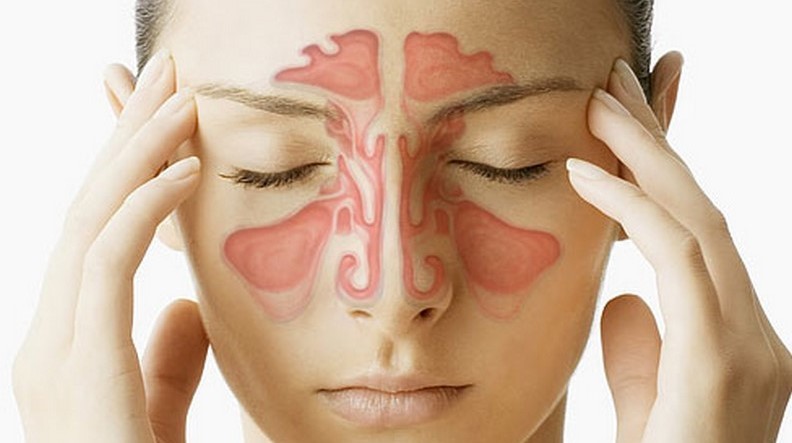 Sinüsler nasıl boşaltılır? Bitkisel sinüzit tedavisi