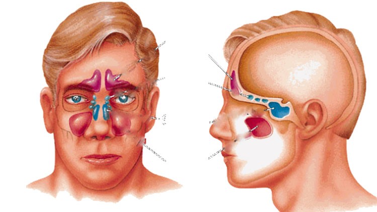 Sinüzit Nasıl Tedavi Edilir?