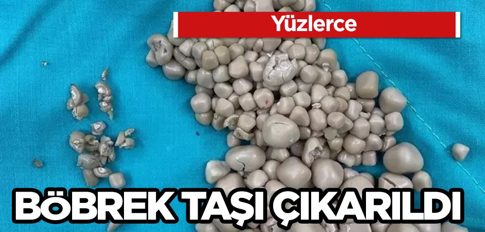 Sırt ağrısı şikayetiyle hastaneye başvurdu! Tayvan'da akılalmaz olay! 300’den fazla böbrek taşı çıkarıldı!