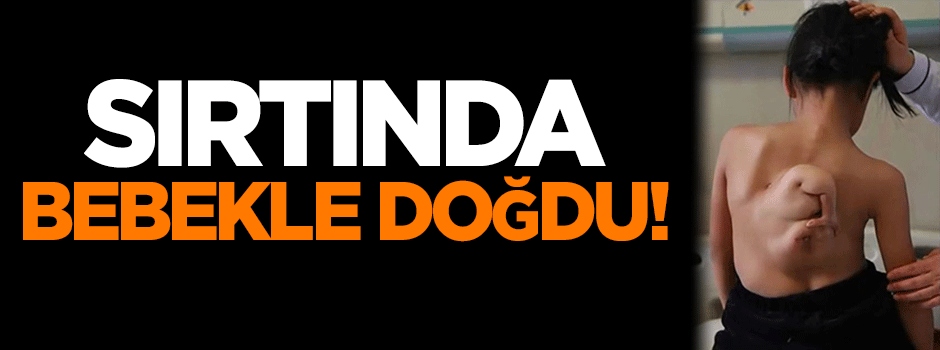 Sırtında bebekle doğdu!