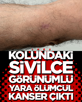 Sivilce deyip geçmeyin! Kolundaki sivilce görünümlü yara ölümcül kanser çıktı!