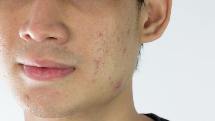  Sivilce izleri nasıl geçer? Evde tedavi yöntemleri nelerdir?