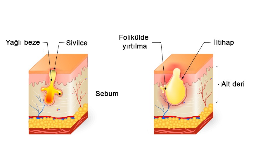 Sivilce nedir ve nasıl oluşur?
