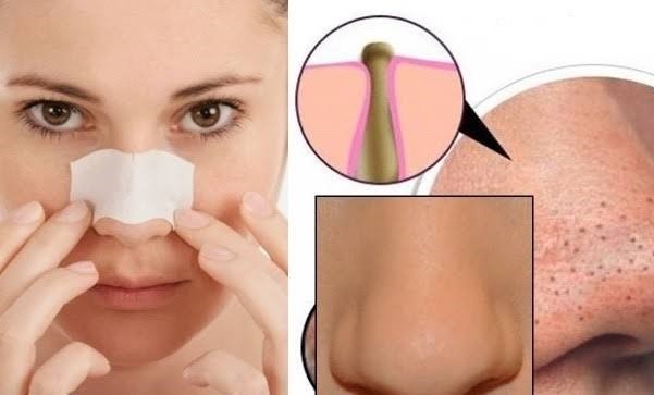 Siyah noktalar için ne iyi gelir?