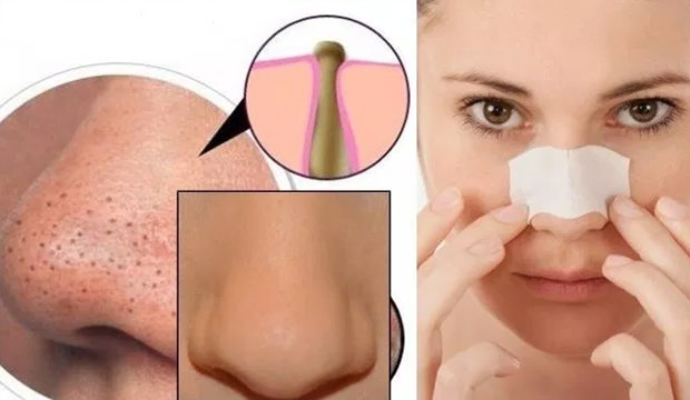 Siyah noktalar nasıl temizlenir doğal yolla?