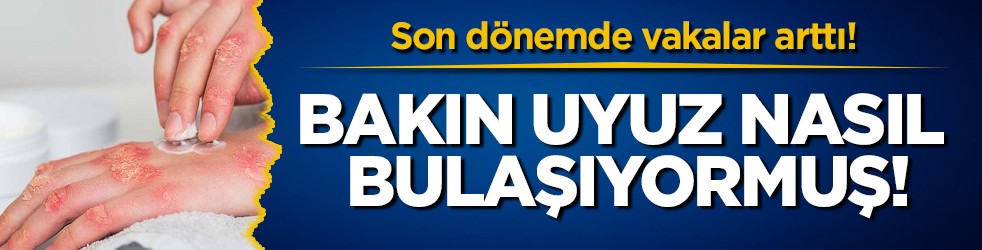 Son dönemde vakalar arttı! Bakın uyuz nasıl bulaşıyormuş!