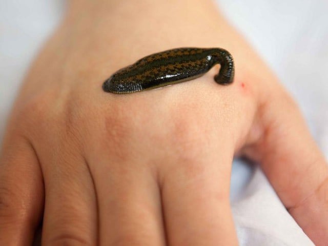 Sülük tedavisi neye iyi gelir?