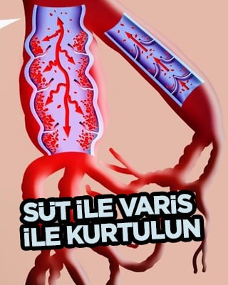 Süt ile varis tedavisi ile kurtulun: Eşi benzeri görülmemiş uygulama