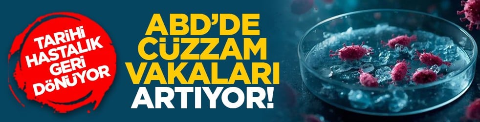 Tarihi hastalık geri dönüyor: ABD’de cüzzam vakaları artıyor!