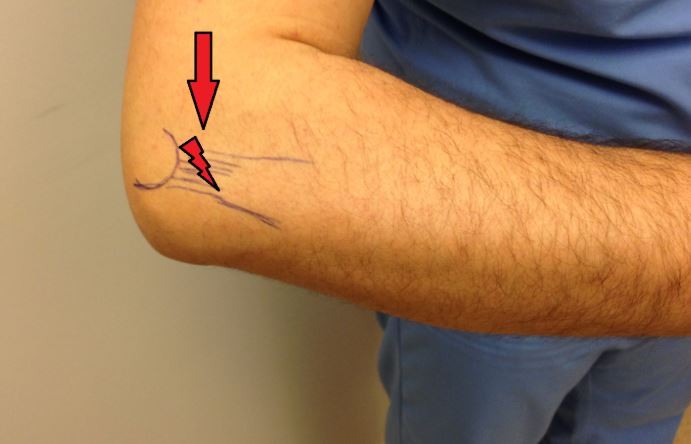 Tenisçi dirseği hastalığı nedir?