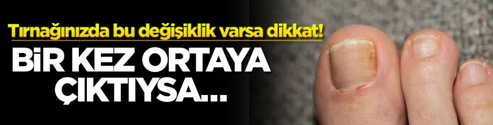 Tırnağınızda bu değişiklik varsa dikkat! Bir kez ortaya çıktıysa...