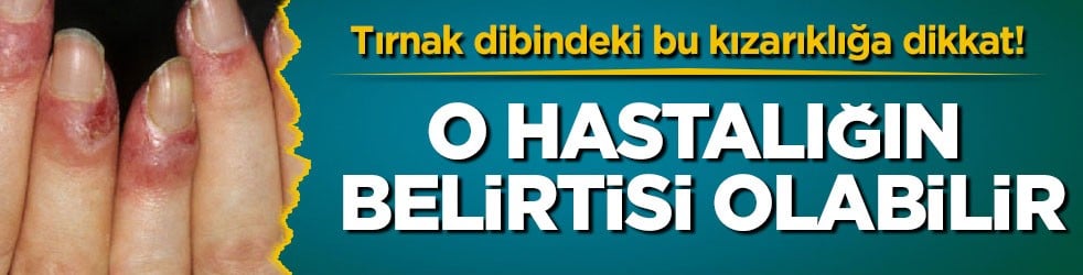 Tırnak dibindeki bu kızarıklığa dikkat! O hastalığın belirtisi olabilir