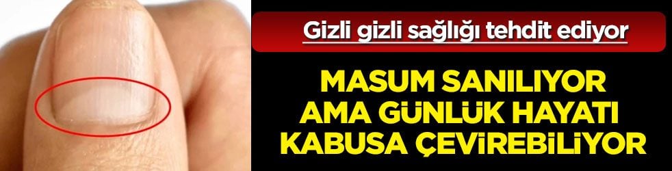 Tırnak diplerine dikkat! Eğer öyleyse bakın hangi hastalıkların habercisiymiş…