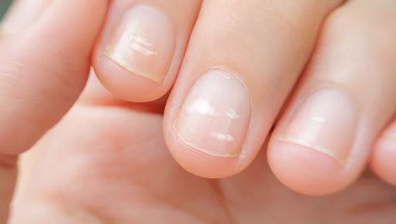 Tırnaklarda beyaz lekeler neden olur?
