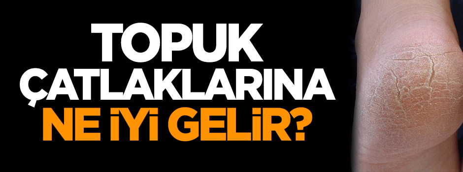 Topuk çatlaklarına ne iyi gelir?
