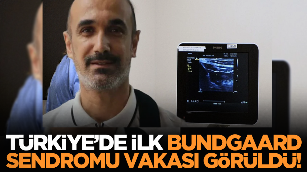 Türkiye’de ilk Bundgaard Sendromu vakası görüldü!