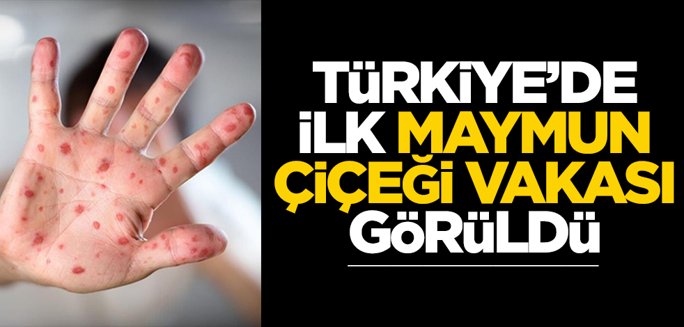 Türkiye'de ilk maymun çiçeği vakası görüldü!