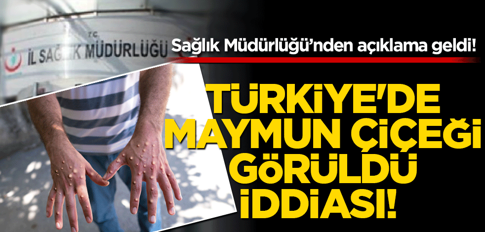 Türkiye'de maymun çiçeği görüldü iddiası! Sağlık Müdürlüğü'nden açıklama geldi
