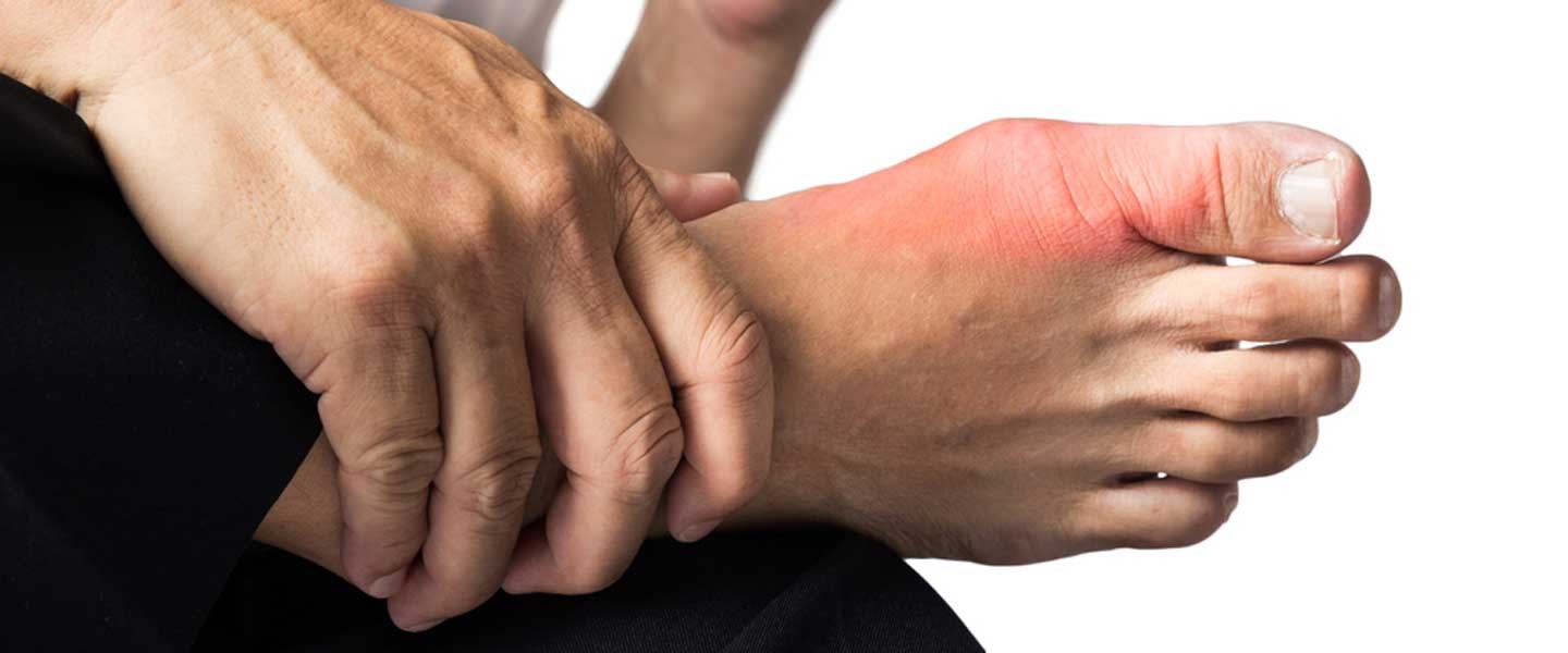 Ürik asit yüksekliği bitkisel tedavisi