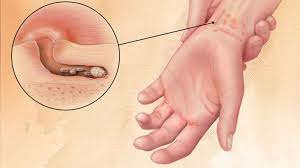 Uyuz belirtileri nasıl olur?