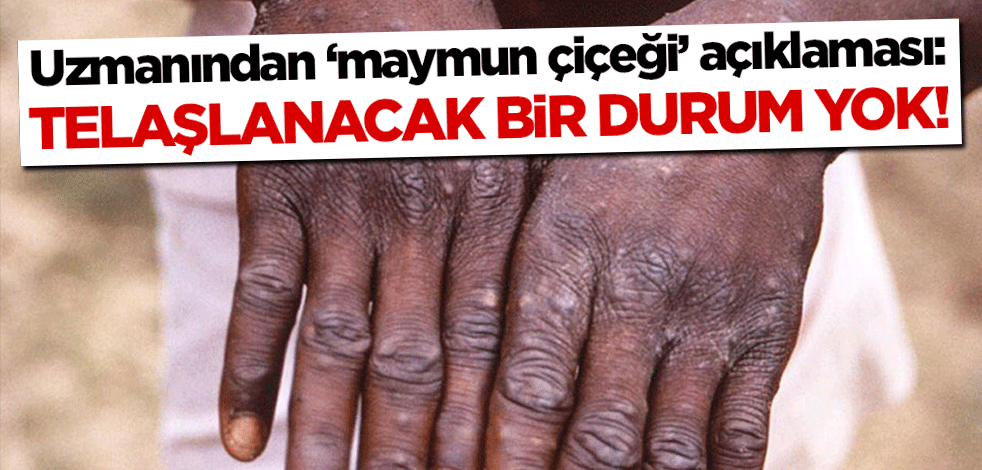 Uzmanından 'maymun çiçeği' açıklaması: Telaşlanacak bir durum yok!