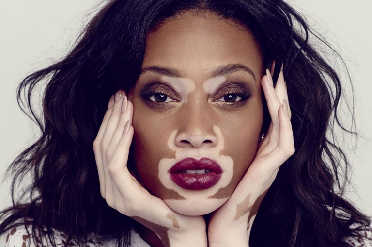 Vitiligo (ala hastalığı) nedir, belirtileri ve tedavisi nedir?