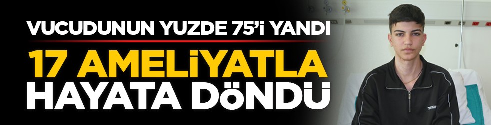 Vücudunun yüzde 75’i yandı: 17 ameliyatla hayata döndü