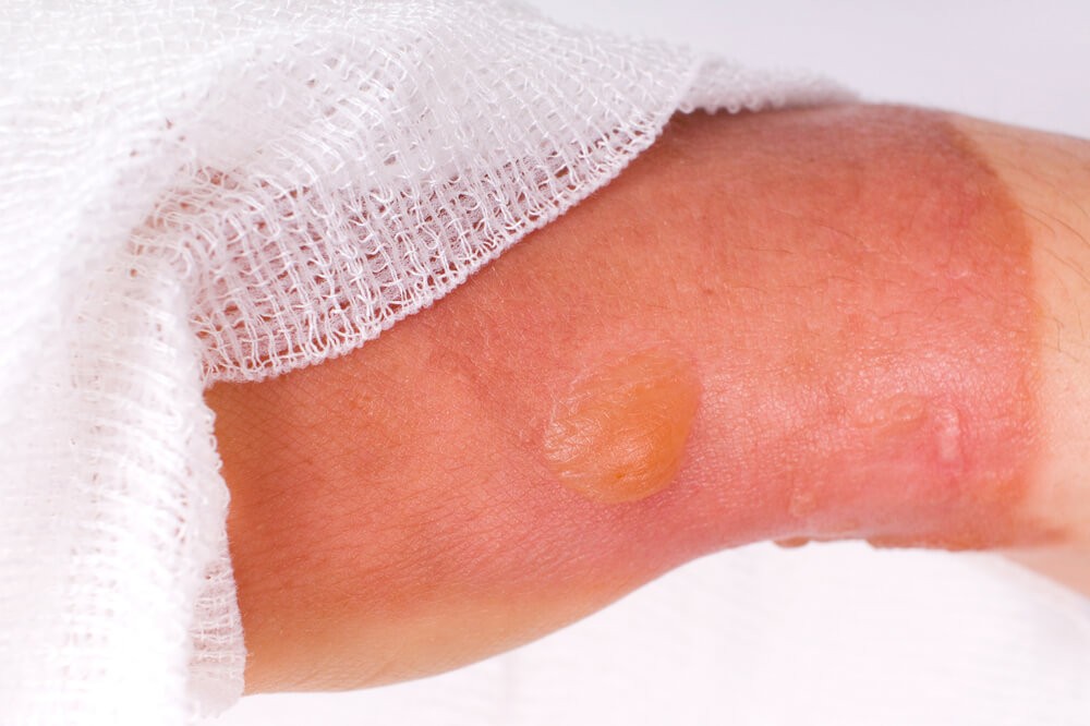 Yanık için ne yapmalı? Yanık tedavisi evde...