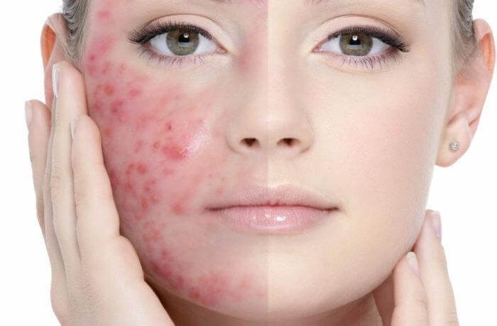 Yediklerimiz sivilce ve siyah nokta oluşumunu etkiler mi?