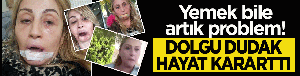 Yemek bile artık problem! Dolgu dudak hayat kararttı