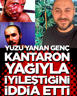 Yüzü yanan genç kantaron yağıyla iyileştiğini iddia etti