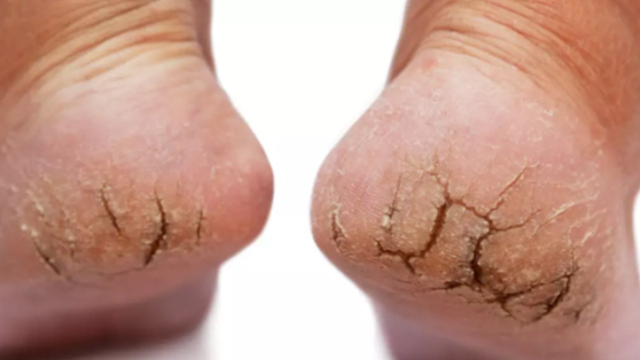 Bunu yapın topuk çatlağı kalmasın: İki malzeme ile yapın! İlaç gibi bir şey...