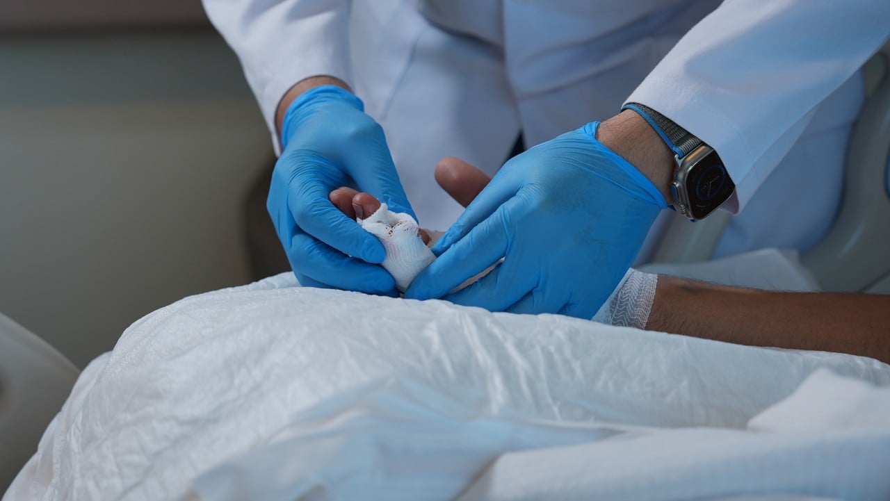 Kazada kopan parmak mikrocerrahi yöntemle tekrar yerine dikildi